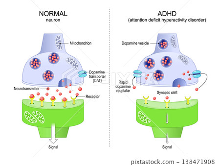 Normal neuron and ADHD neuron. Attention deficit hyperactivity disorder. Normal neuron and ADHD neuron. Attention deficit hyperactivity disorder. 138471908
