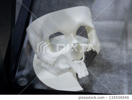 Prototype of a human skull from white plastic with an implant from biocompatible titanium printed on a 3D printer. Bioengineering patient-specific slit-facial prosthesis. Prototype of a human skull from white plastic with an implant from biocompatible titanium printed on a 3D printer. Bioengineering patient-specific slit-facial prosthesis. 138508948