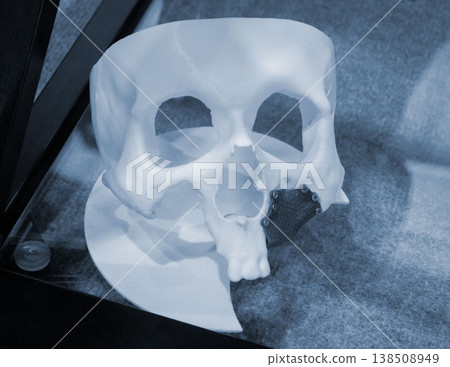 Prototype of a human skull from white plastic with an implant from biocompatible titanium printed on a 3D printer. Bioengineering patient-specific slit-facial prosthesis. Prototype of a human skull from white plastic with an implant from biocompatible titanium printed on a 3D printer. Bioengineering patient-specific slit-facial prosthesis. 138508949
