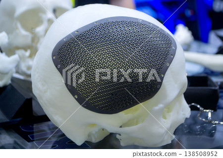 Titanium cranioplates. Prototype of human skull from white plastic with individual patient-specific cranial plate grid made of biocompatible titanium printed on 3D printer. Bioengineering implant 138508952