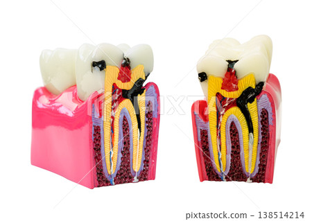 Dental implant, artificial tooth roots into jaw model. Dental implant, artificial tooth roots into jaw model. 138514214