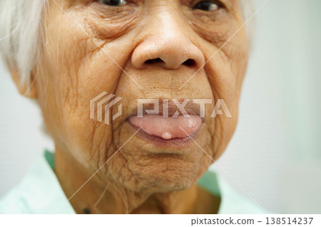Cysts at the tongue in mouth of Asian elderly old lady woman patient. Cysts at the tongue in mouth of Asian elderly old lady woman patient. 138514237