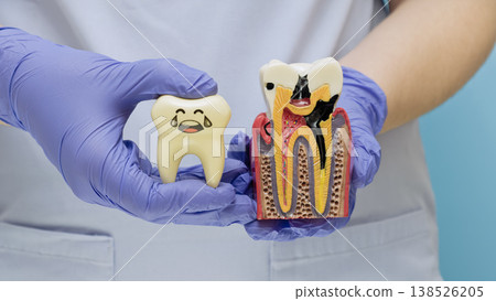 Dentist hands in purple gloves holding a healthy happy tooth toy and a cross-section model of a decayed tooth with caries. Dentist hands in purple gloves holding a healthy happy tooth toy and a cross-section model of a decayed tooth with caries. 138526205