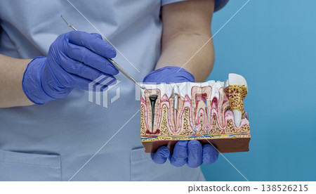 Dentist pointing at tooth root canal infection and pulpitis on anatomical jaw cross-section model. 138526215