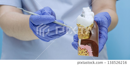 Dentist pointing at dental tartar and gum disease on anatomical tooth model with professional probe. 138526216
