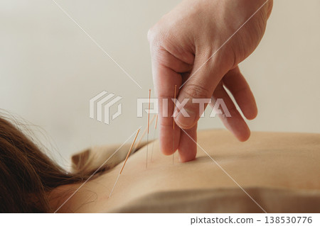 A close-up of the acupuncturist's fingertips as they carefully insert needles, showcasing painless treatment and a reassuring practice scene. 138530776