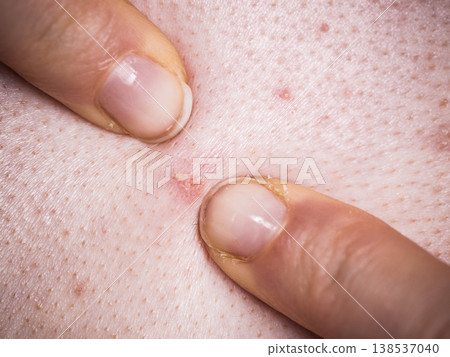 Woman dealing with pimples red spots 138537040