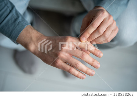 Male with hand skin dryness between fingers, symptoms of dehydration or seasonal vitamin deficiency. 138538262