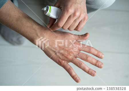 Man applying gel on painful areas of hands skin to cure cracks and dryness caused by winter season. Man applying gel on painful areas of hands skin to cure cracks and dryness caused by winter season. 138538328
