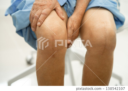 Asian elderly woman patient show her scars surgical total knee joint replacement Suture wound surgery arthroplasty on bed in hospital. 138542107