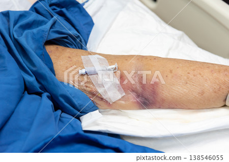 Close up of patient arm with bruising and IV line showing medical treatment recovery process and healthcare monitoring in hospital environment Close up of patient arm with bruising and IV line showing medical treatment recovery process and healthcare monitoring in hospital environment 138546055