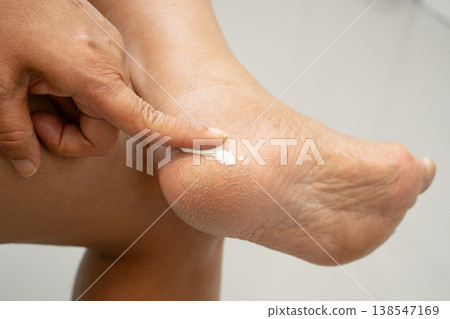 Asian woman applying moisturizing cream skincare treatment to solve and repair feet with crack and dry heel skin. 138547169