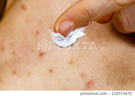 Woman with pimple on back applying medical ointmeny 138553670