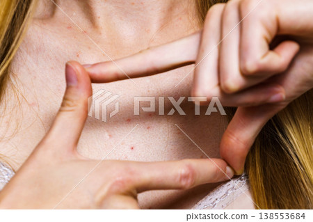 Woman with skin problem acne on neckline 138553684