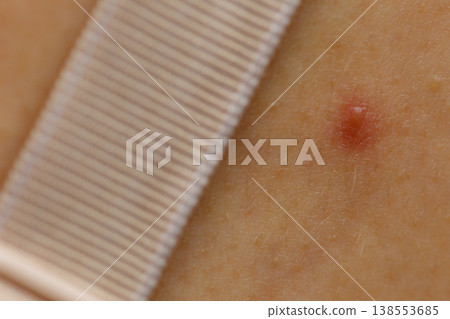 Closeup skin with acne moles and red spots. Closeup skin with acne moles and red spots. 138553685