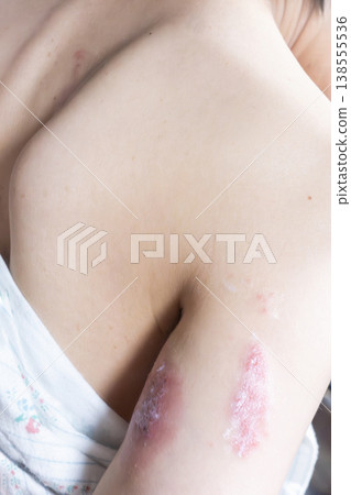 Woman with shingles on the skin she feels very painful Woman with shingles on the skin she feels very painful 138555536