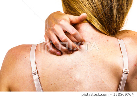 Woman with skin problem acne on back Woman with skin problem acne on back 138569764