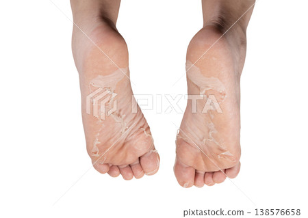 Peeling Skin on Human Foot Sole Close Up. Exfoliating Dead Skin on Human Foot Close Up. Foot Care Problem Peeling Skin Texture. Dry Peeling Skin on Foot Sole Detail. Peeling Skin on Human Foot Sole Close Up. Exfoliating Dead Skin on Human Foot Close Up. Foot Care Problem Peeling Skin Texture. Dry Peeling Skin on Foot Sole Detail. 138576658