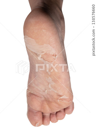 Peeling Skin on Human Foot Sole Close Up. Exfoliating Dead Skin on Human Foot Close Up. Foot Care Problem Peeling Skin Texture. Dry Peeling Skin on Foot Sole Detail. 138576660