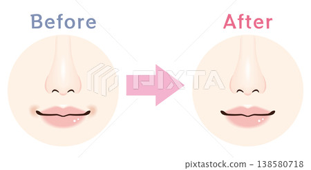 Before and After Illustrations of dullness around the mouth 138580718