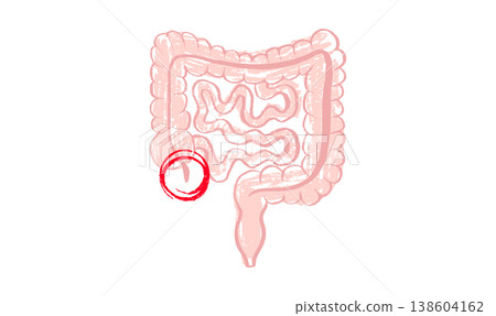 Inflamed appendix scetch 138604162