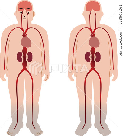 Diseases caused by vascular disorders in the human body. Illustrations of aneurysms, heart, kidney, and lower limb diseases. Diseases caused by vascular disorders in the human body. Illustrations of aneurysms, heart, kidney, and lower limb diseases. 138605261