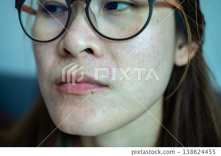 Cropped shot view of acne occur on Asian woman face. Allergies, irritants, genetic makeup, etc can cause skin conditions. Cropped shot view of acne occur on Asian woman face. Allergies, irritants, genetic makeup, etc can cause skin conditions. 138624455