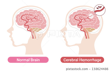 Comparison of a brain with a brain hemorrhage and a normal brain: Medical illustration (English version) 138624486