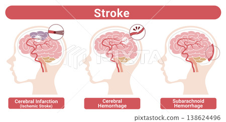 Types of Stroke (Cerebral Infarction, Cerebral Hemorrhage, Subarachnoid Hemorrhage) - Medical Illustrations (English Version) Types of Stroke (Cerebral Infarction, Cerebral Hemorrhage, Subarachnoid Hemorrhage) - Medical Illustrations (English Version) 138624496