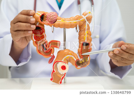 Colorectal cancer, doctor holding intestine colon human anatomy model. Colorectal cancer, doctor holding intestine colon human anatomy model. 138648799
