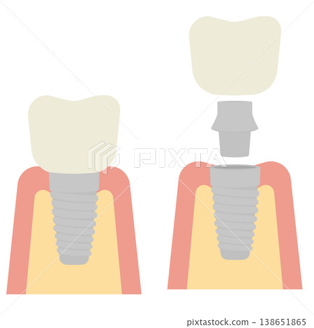 牙科植體示意圖 138651865