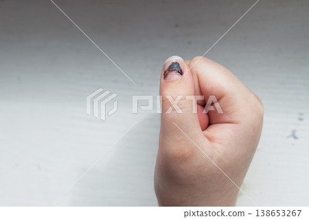 Child hand with injured nail and subungual hematoma Child hand with injured nail and subungual hematoma 138653267