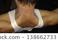 View of a young man neck. Dermatology, allergy, itching, red spot or rash on skin, health care and medical concept. 138662733