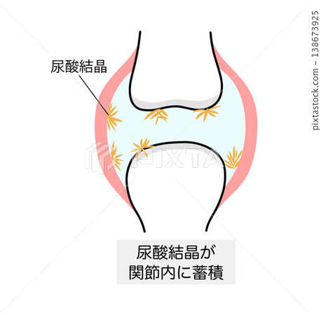圖示為痛風中沉積的尿酸晶體在關節處的分佈。 138673925
