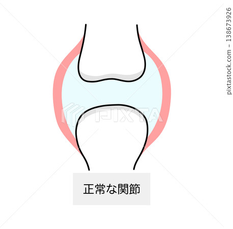 痛風患者正常關節示意圖 痛風患者正常關節示意圖 138673926