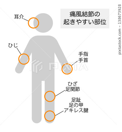 圖示痛風石易發區域。 圖示痛風石易發區域。 138673928