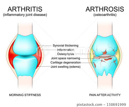Arthritis vs Arthrosis. Symptoms of Inflammatory joint disease and Osteoarthritis. Arthritis vs Arthrosis. Symptoms of Inflammatory joint disease and Osteoarthritis. 138691999
