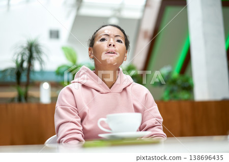 Black african american woman with vitiligo 138696435