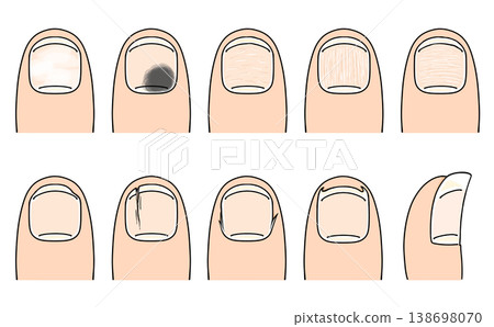 A set of loosely painted, simple, and slightly abnormal nail designs. A set of loosely painted, simple, and slightly abnormal nail designs. 138698070