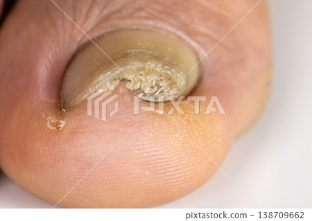 Ingrown toenail on a senior feet with white backgroundClose-up ingrown toenail on senior feet with white background. 138709662