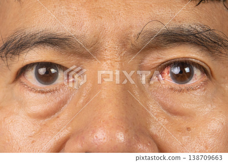 Blunt Eye Trauma , An eye impact injury causing potential damage to the eyeball. Blunt Eye Trauma , An eye impact injury causing potential damage to the eyeball. 138709663