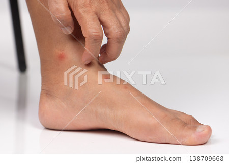 Close up view of flea bites on lower legs and feet skin. 138709668