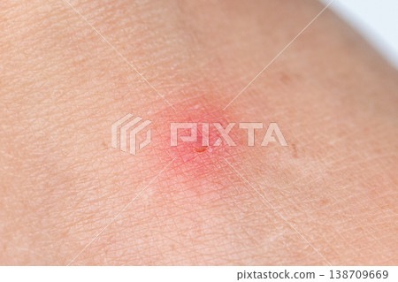 Close up view of flea bites on lower legs and feet skin. Close up view of flea bites on lower legs and feet skin. 138709669