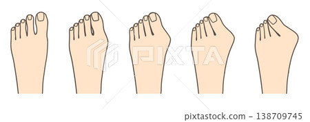 圖示比較了拇趾外翻的症狀發展過程。 138709745