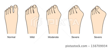 圖示對比了拇外翻症狀（輕度、中度、重度）的進展情況 138709934
