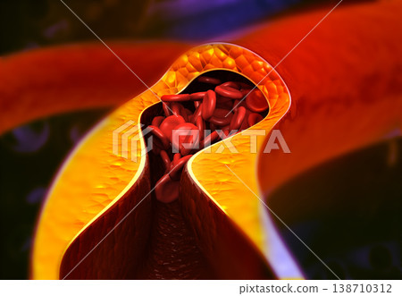 Artery blocked with bad cholesterol Artery blocked with bad cholesterol 138710312