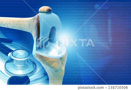 Knee joint replacement. medical background concept Knee joint replacement. medical background concept 138710506