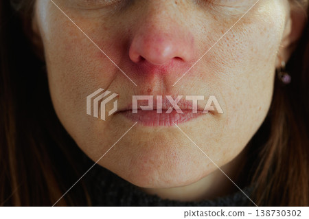 Middle-Aged Woman with Facial Redness and Skin Irritation 138730302