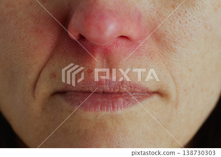 Close-Up of Irritated Skin and Chapped Lips from Cold Close-Up of Irritated Skin and Chapped Lips from Cold 138730303