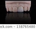 Mirror copy of central maxillary incisor, ultra thin dental ceramic veneer or crown on printed model 138765480
